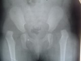 Dislocation of Hip Treatment