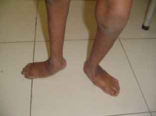 Meningo Myelocoele Treatment