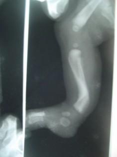 Postero-Medial Bowing of Tibia