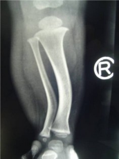 Postero-Medial Bowing of Tibia