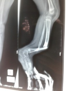 Pseudoathrosis of Tibia