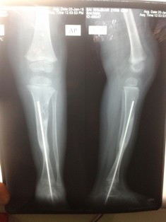 Pseudoathrosis of Tibia