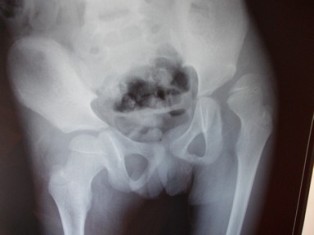 Dislocation of Hip Treatment