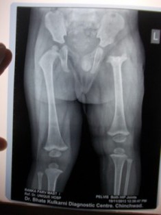 Septic Arthritis and Osteomyelitis Treatment