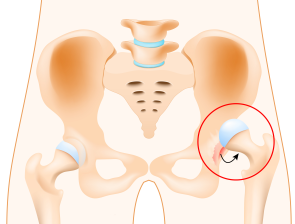 Dislocation of Hip in Pune