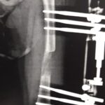 Radiograph after 1 month showing lengthening of bone and regenerate