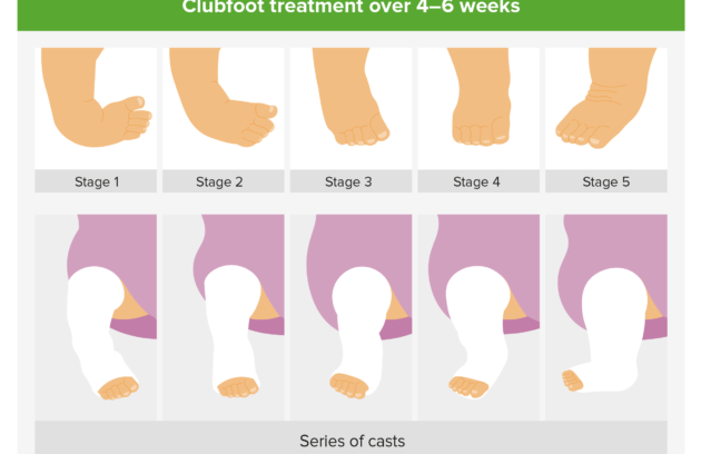Treatment Options for Clubfoot: What You Need to Know