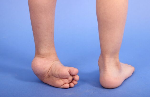 Understanding Clubfoot: Causes, Symptoms, and Diagnosis