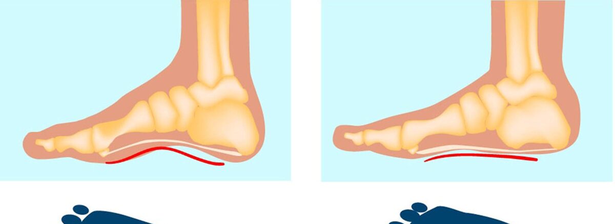 Understanding Flat Feet: Your Guide to Foot Health
