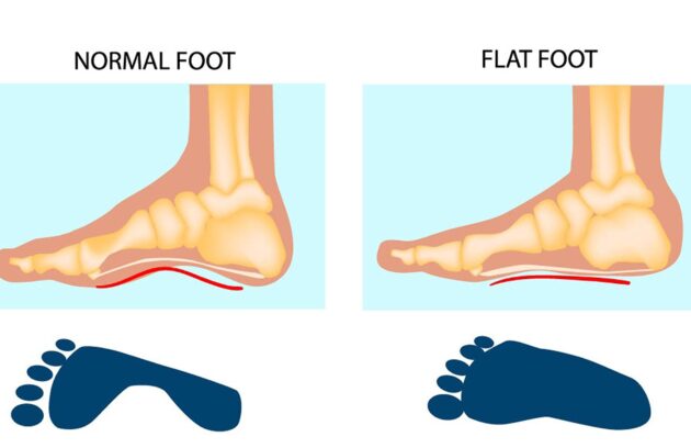 Understanding Flat Feet: Your Guide to Foot Health