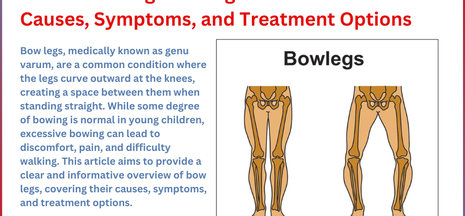 Understanding Bow Legs: Causes, Symptoms, and Treatment Options by Dr. Sameer Desai