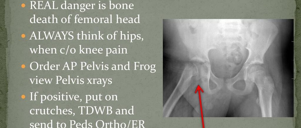 Slipped Capital Femoral Epiphysis treatment