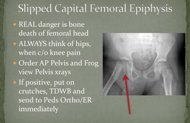 Slipped Capital Femoral Epiphysis treatment