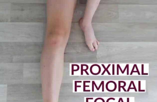 Proximal Femoral Focal Deficiency treatment