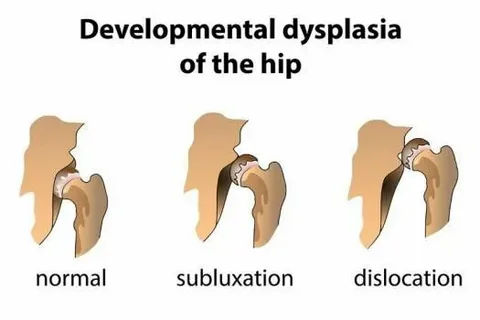 Developmental Dysplasia of the Hip (DDH) Treatment in Pune