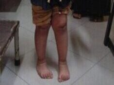 Best Intoe Gait Treatment in Pune