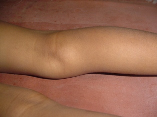 Best M B Cyst Treatment in Pune