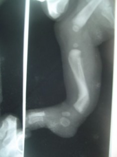 Best Postero Medial Bowing Of Tibia treatment in pune