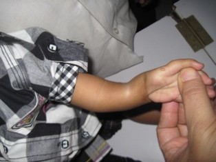 Best Radial Clubhand treatment in Pune