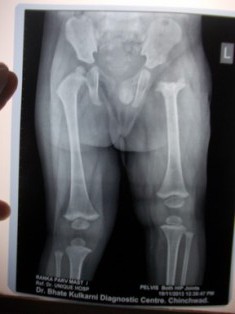 Best Septic Arthritis And Osteomyelitis in Pune