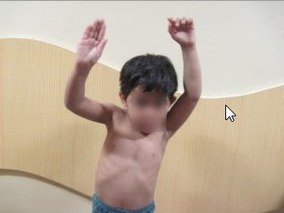 Best Sprengel Shoulder Treatment in Pune