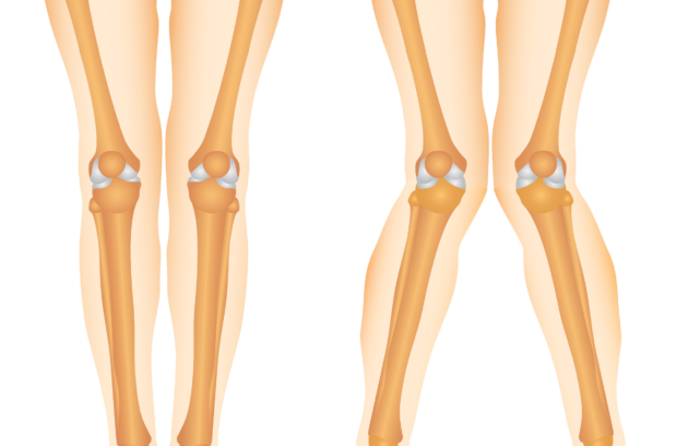 Knock Knee Specialist in Pune