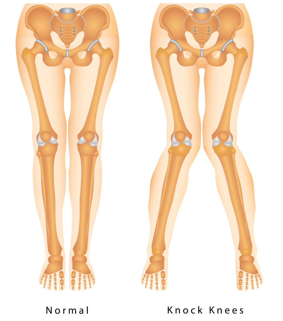 Knock Knee Specialist in Pune