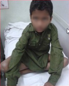 Best Perthes Disease treatment in Pune