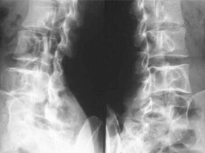 Best Fibrous-dysplasia Treatment in Pune