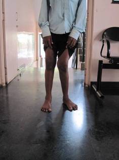 Best Knock-Knee Treatment In Pune