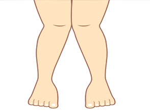 Best Knock-knee Treatment in Pune