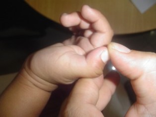 Best Trigger-thumb treatment in Pune