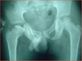 Best Perthes-Disease treatment in Pune