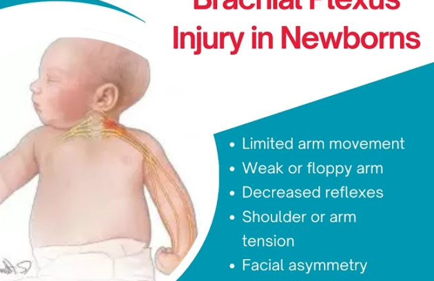 Early Signs of Brachial Plexus Injury in Newborns