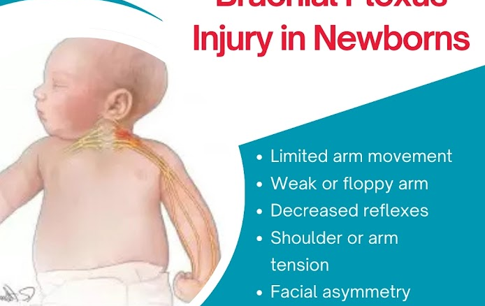 Early Signs of Brachial Plexus Injury in Newborns