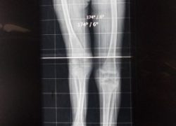 Long leg radiograph showing 10 cm shortening of right lower limb