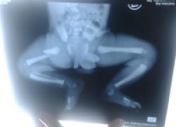 Newborn femur fracture