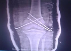 Fracture fixed with K wire