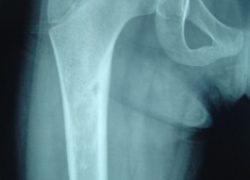Radiograph of hip showing osteoid osteoma at neck of femur