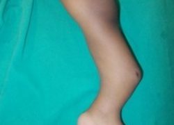 Clinical photo showing bowing of tibia