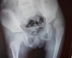 Radiograph of hip showing dislocation of left hip