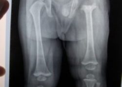 Radiograph showing destruction of head of left femur following septic arthritis
