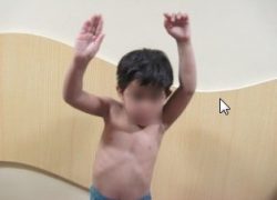 Clinical photo showing decreased abduction of right shoulder