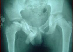 Radiograph showing Perthes disease of left hip